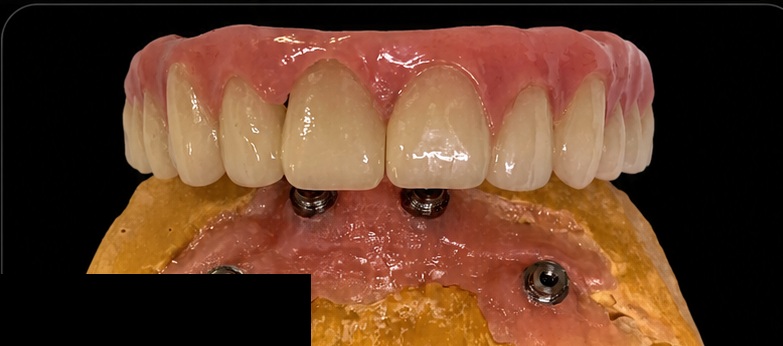 Hybrid denture